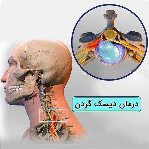 درمان دیسک گردن