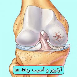 آرتروز و آسیب رباط ها