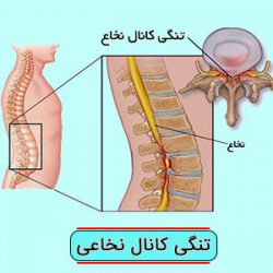 تنگی کانال نخاعی