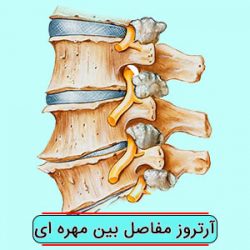آرتروز مفاصل بین مهره ای