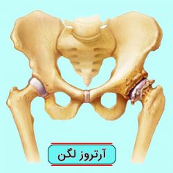 آرتروز لگن