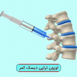اوزون تراپی دیسک کمر