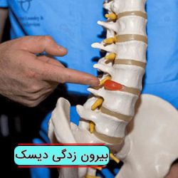 بیرون زدگی دیسک