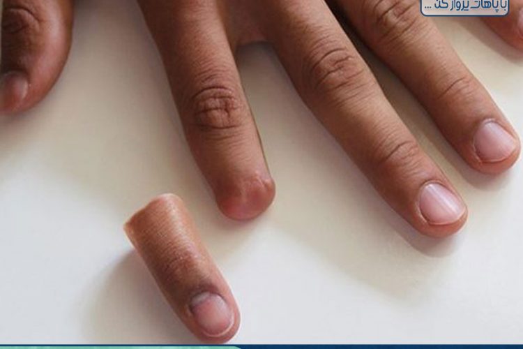 انگشت مصنوعی چیست و چگونه کار می کند؟